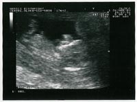 Ultrasound